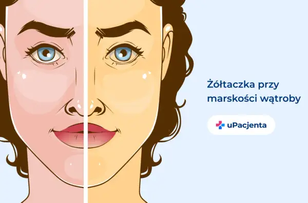 Twarz podzielona na dwie części: zdrową i zażółconą, ilustrująca żółtaczkę przy marskości wątroby.